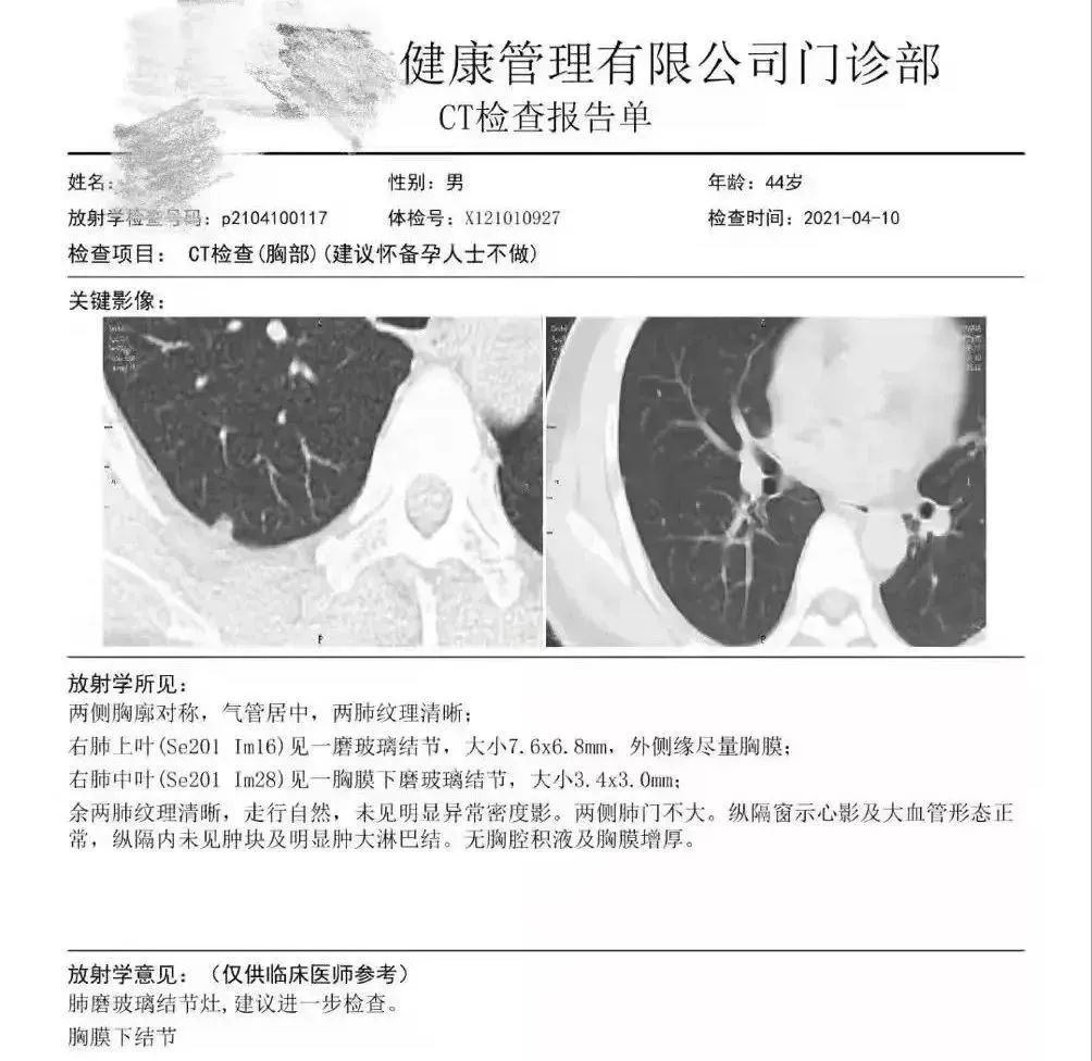 結果發(fā)現王先生右肺胸膜表面下（肺的內部），存在兩枚磨玻璃結節，其中較大者直徑7.6mm。