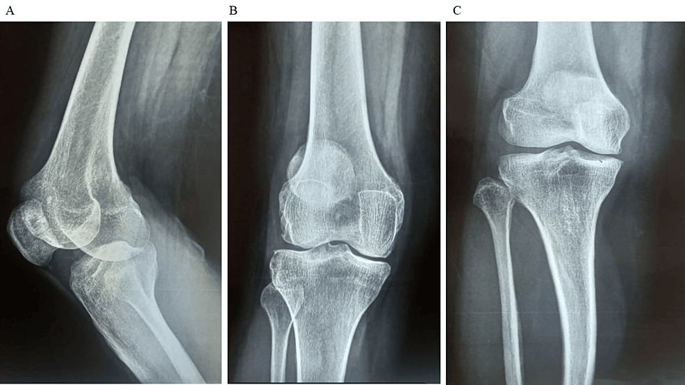 圖1：顯示了開(kāi)始干細胞治療之前的骨骼側視圖和前后視圖。