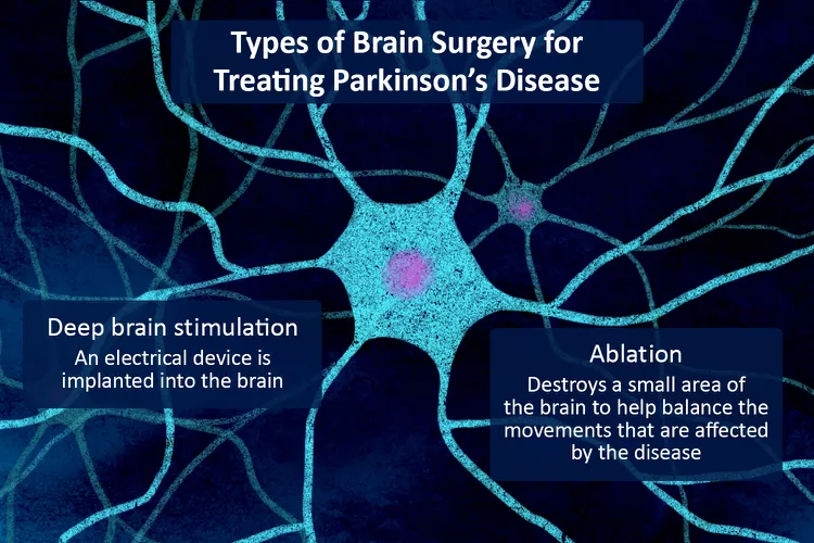 帕金森病的腦部手術(shù)：類(lèi)型、恢復和風(fēng)險