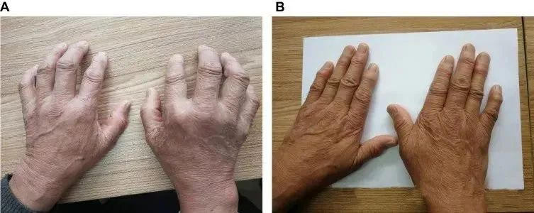 一名68歲男性被診斷患有類(lèi)風(fēng)濕性關(guān)節炎治療前后的對比 