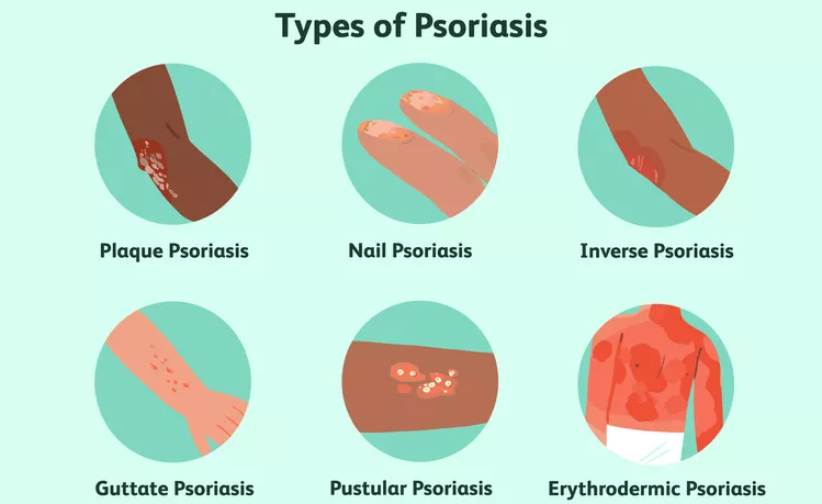 盤(pán)點(diǎn)國內各大醫院運用干細胞治療銀屑病的臨床應用