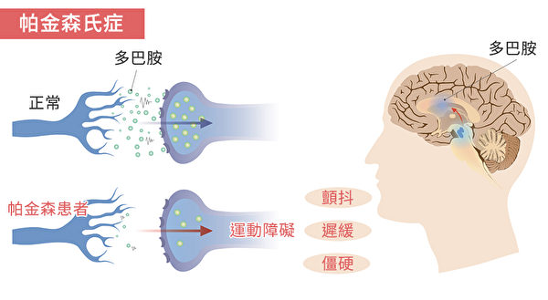 帕金森病 (PD) 的常見(jiàn)癥狀 帕金森病 (PD) 的常見(jiàn)癥狀