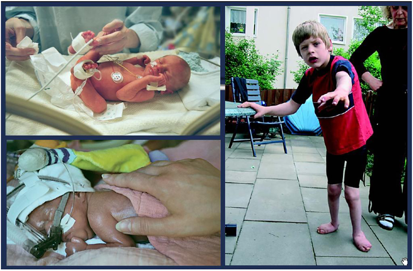 腦癱 (CP) 是兒童期最常見(jiàn)的殘疾，是一種嚴重的非進(jìn)行性嬰幼兒腦部疾病，具有終身后遺癥