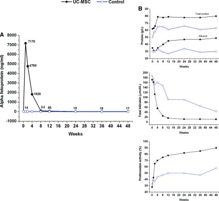 UC-MSC 輸血改善了一名急性慢性肝衰竭患者的血清 α-胎蛋白 (α-FP) 水平。