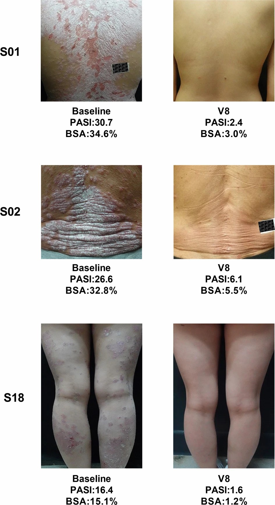 三名患者經(jīng)過(guò)治療后根據 PGA 評分顯示無(wú)疾病跡象（評分為 0）或輕微疾?。ㄔu分為 1）。