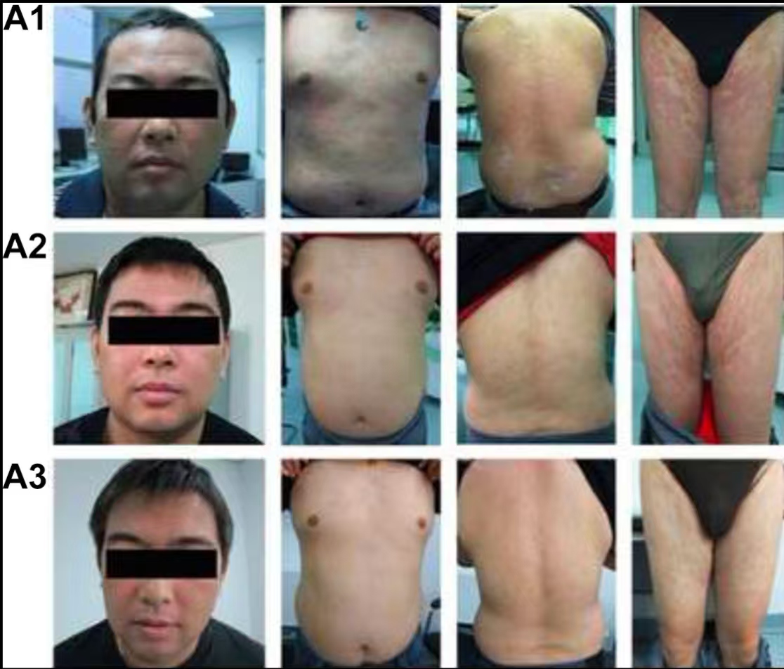 圖A1是患者治療前的皮膚情況

圖A2是患者治療6個(gè)月之后的皮膚情況

圖A3是患者治療12個(gè)月之后的皮膚情況