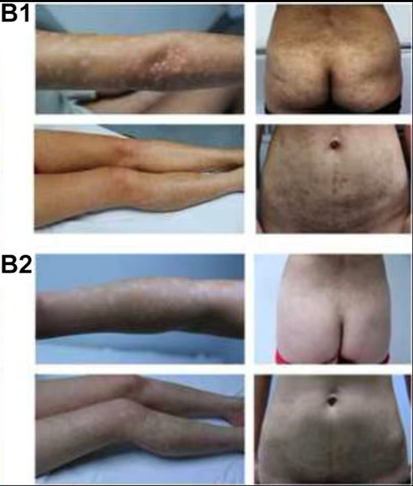 （圖B1）患者入院后體檢發(fā)現，患者全身遍布橙紅色斑塊，上面覆有銀色鱗屑

（圖B2）治療初期，我院給予患者3次臍帶間充質(zhì)干細胞，連續3周回輸，患者全身表面逐漸恢復光滑