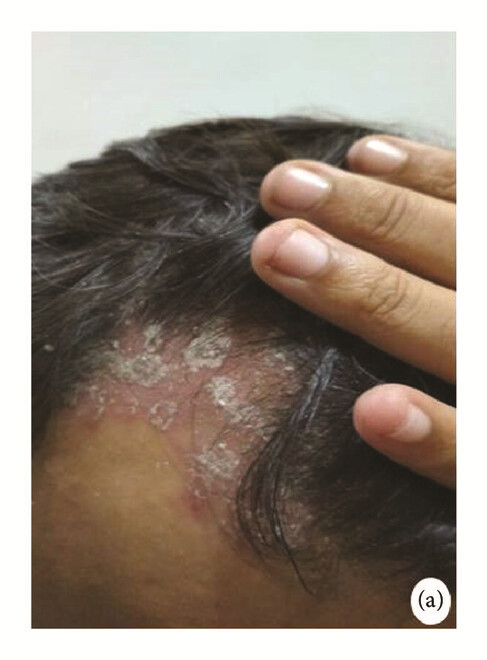 骨髓間充質(zhì)干細胞 治療前，患者頭皮上出現大量紅斑，并附著(zhù)銀色鱗片（a）。