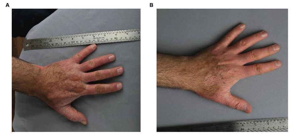 患者3細胞移植6個(gè)月后，注射部位的紅斑、脫屑和厚度明顯減少。皮膚厚度從2.1毫米減少到1.7毫米，與手部健康部位相似。該患者報告生活質(zhì)量有所提高。PASI評分在注射細胞后從4.7變?yōu)?.3。