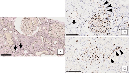 圖1：住院第 31 天的腎臟活檢結果。