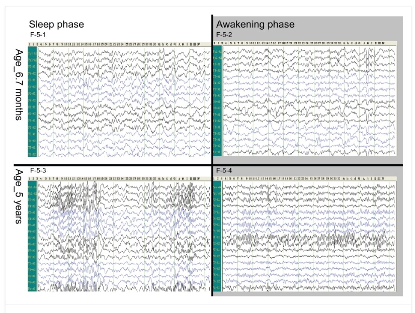 圖5.腦電圖。