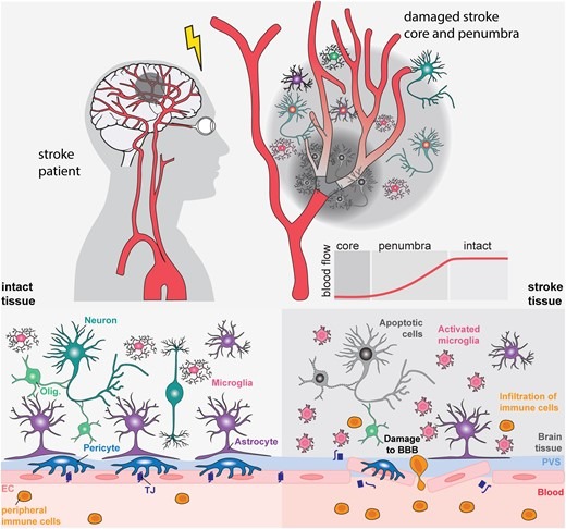 圖1：中風(fēng)的病理生理學(xué)