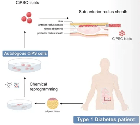 干細胞技術(shù)將成為糖尿病治療的新里程碑