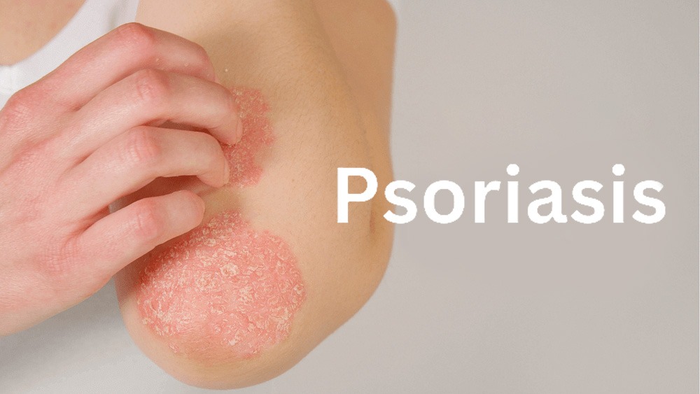 銀屑病治療新篇章：盤(pán)點(diǎn)2020-2024年干細胞治療銀屑病臨床研究進(jìn)展