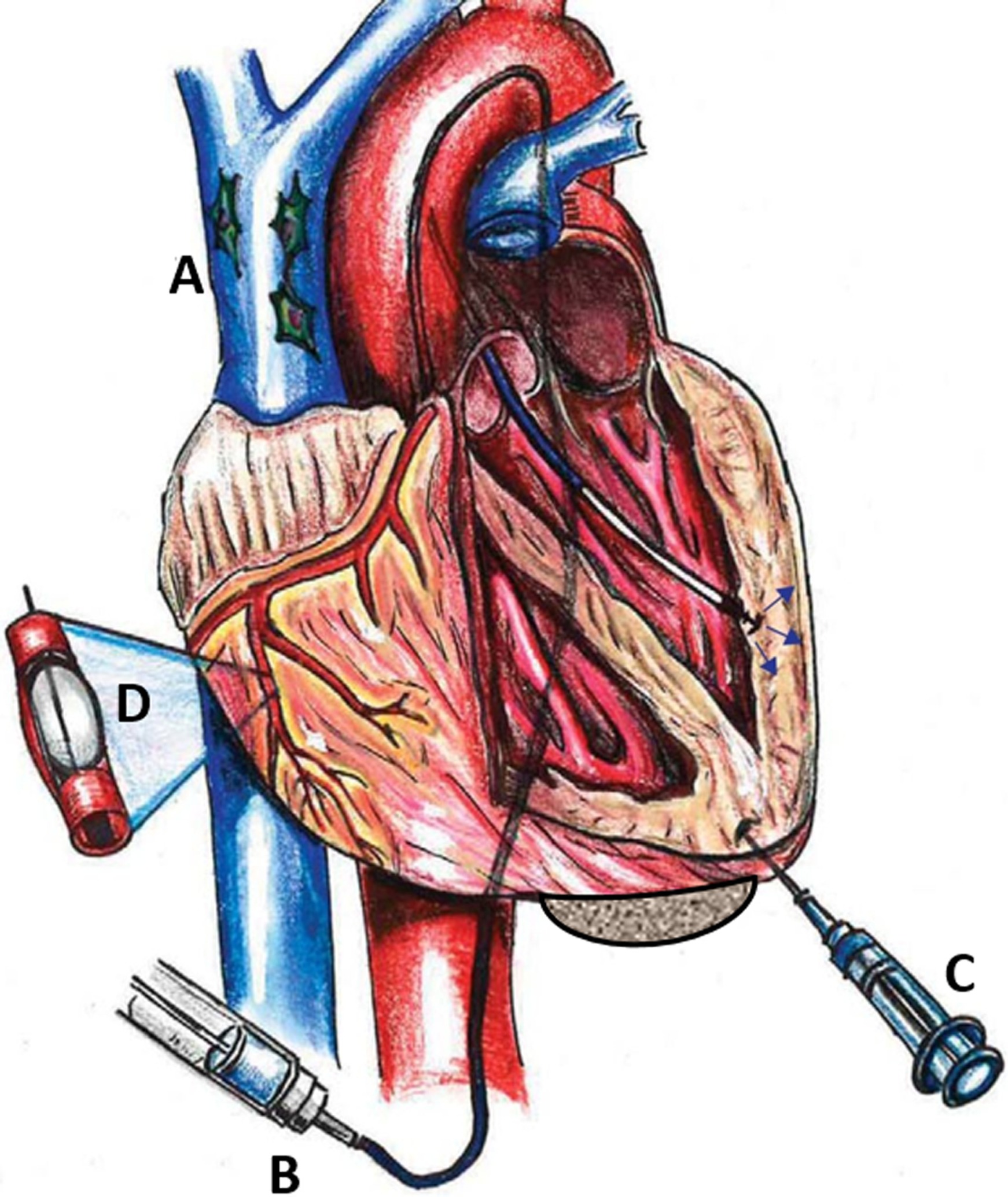 圖1：MSC通過(guò)系統 (Sys) 和局部 (Loc) 途徑進(jìn)入心臟。