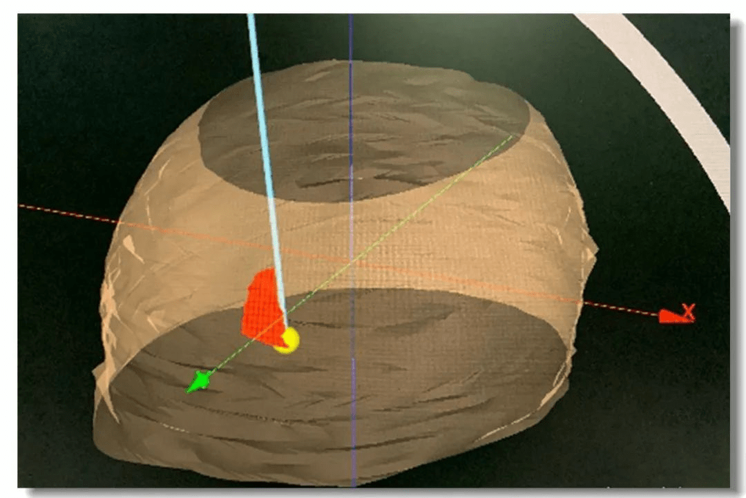 圖1:立體定向手術(shù) 圖1:立體定向手術(shù)