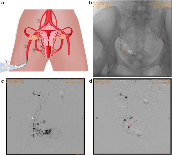圖 2：通過(guò)卵巢?動(dòng)脈精確輸注 hAEC。