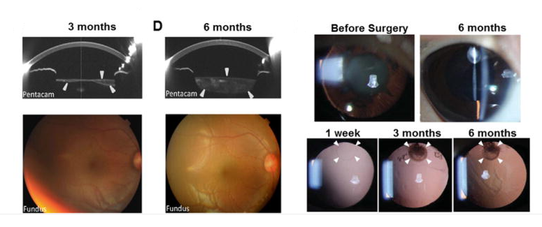 手術(shù)后六個(gè)月，囊袋充滿(mǎn)了再生晶狀體組織