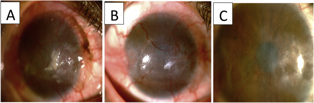 右眼 眼表鱗狀腫瘤照片。