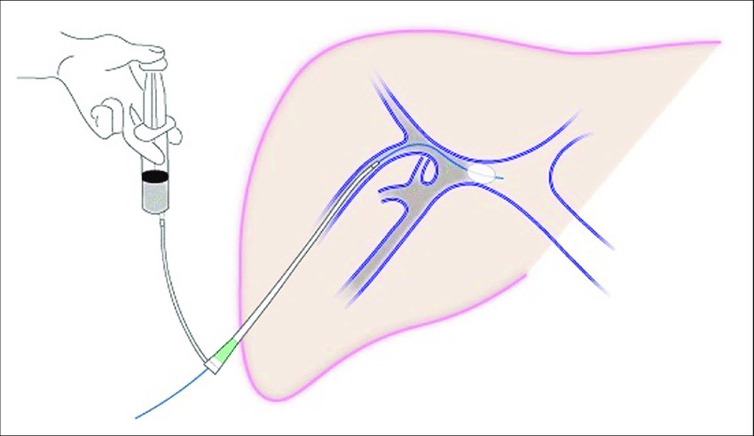 肝門(mén)靜脈輸注 肝門(mén)靜脈輸注