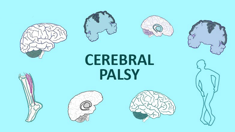 從步履蹣跚到穩健行走：干細胞技術(shù)如何重塑腦癱兒童平衡能力？