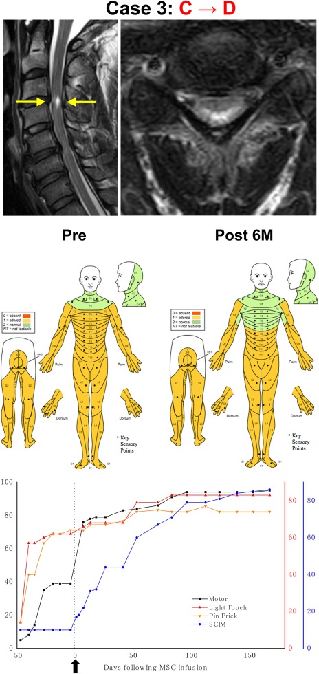 干細胞治療后患者的恢復狀態(tài)圖
