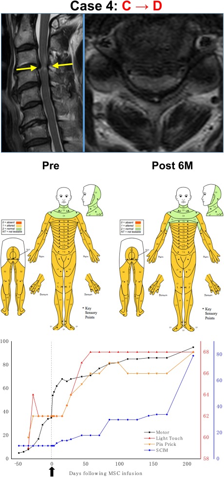 干細胞治療后患者的恢復狀態(tài)圖