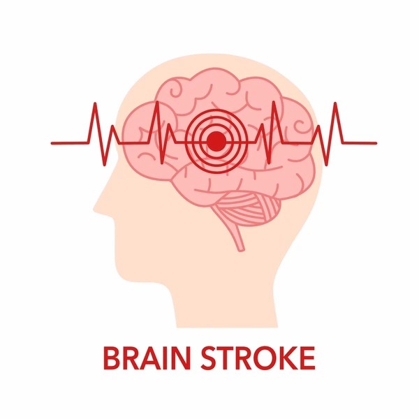 直擊腦卒中：神經(jīng)干細胞移植的治療方法有哪些？