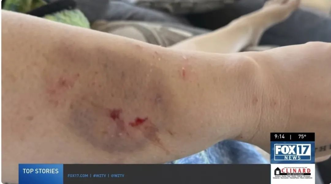 在接受干細胞治療前表現出嚴重的自閉癥癥狀，甚至曾咬傷母親安吉拉，留下了永久的疤痕