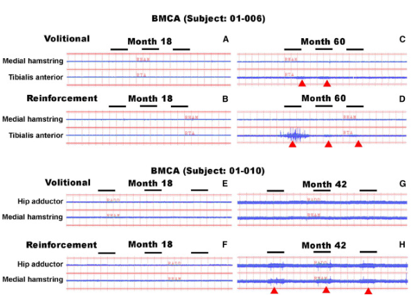 BMCA 識別自愿或強化動(dòng)作引發(fā)的 EMG 活動(dòng)