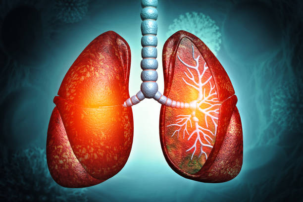 間充質(zhì)干細胞治療4大類(lèi)肺部疾病的臨床試驗進(jìn)展及挑戰 間充質(zhì)干細胞治療4大類(lèi)肺部疾病的臨床試驗進(jìn)展及挑戰