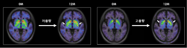 
低劑量和高劑量TED-A9植入一年后的腦成像。
