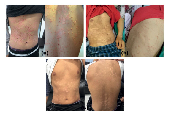 G-MSC 輸注對患有 5 年嚴重斑塊性銀屑病的 19 歲男性的影響。