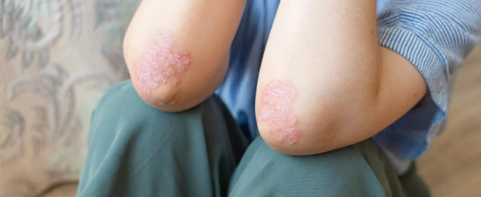 干細胞治療銀屑?。喝绾螌?shí)現從短期銀屑病面積減少到長(cháng)期皮膚恢復正常？