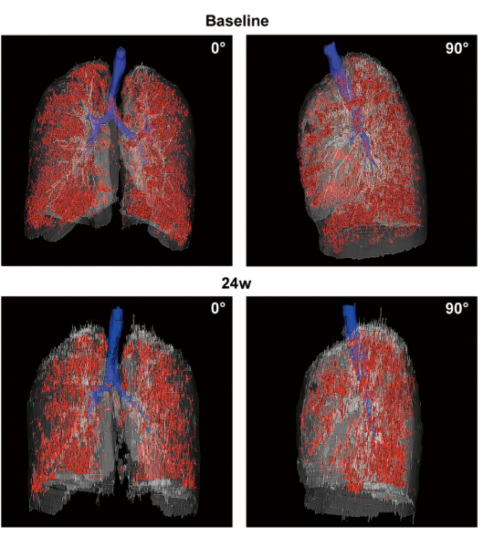患者 #2902 自體 P63 細胞移植前和后 24 周連續肺部 CT 圖像的三維可視化。