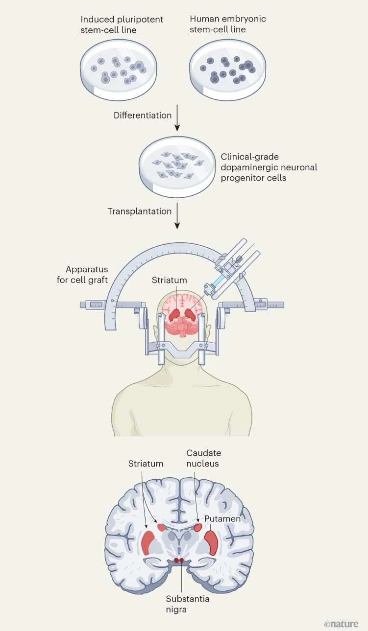 圖1：帕金森病的干細胞療法。