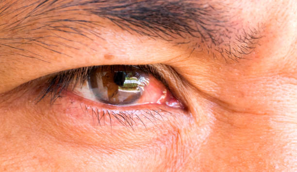 南京鼓樓醫院全球首發(fā)臍帶間充質(zhì)干細胞滴眼液，為難治性干眼癥患者治療迎來(lái)新曙光