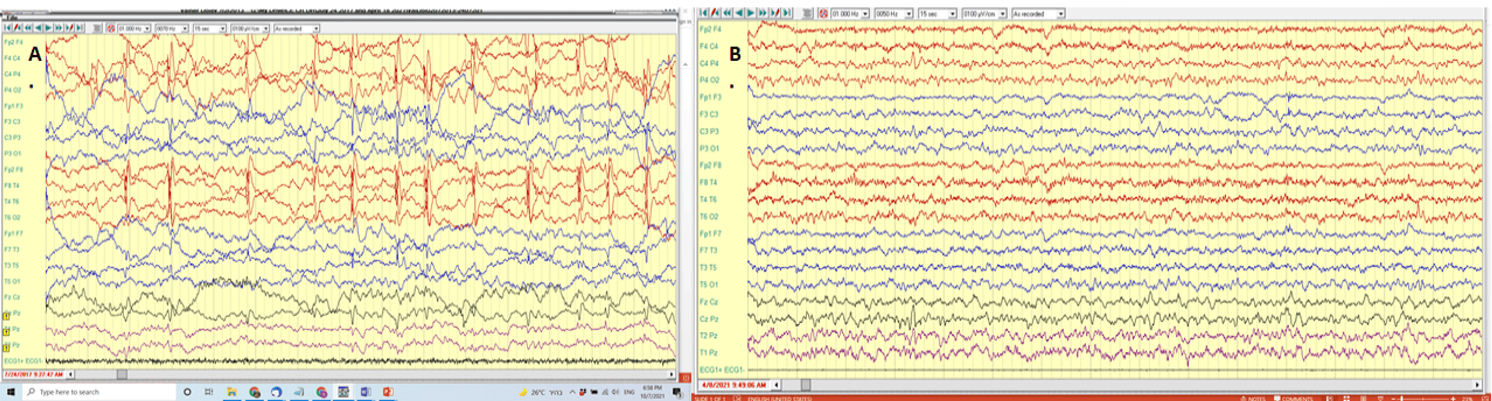 圖1:alloMSCT#1前后的腦電圖結果 圖1:alloMSCT#1前后的腦電圖結果