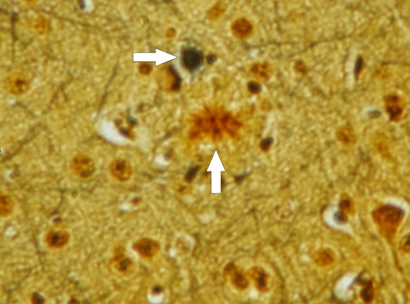 圖4：本圖描繪了三重轉基因小鼠模型中阿爾茨海默病的病理特征。