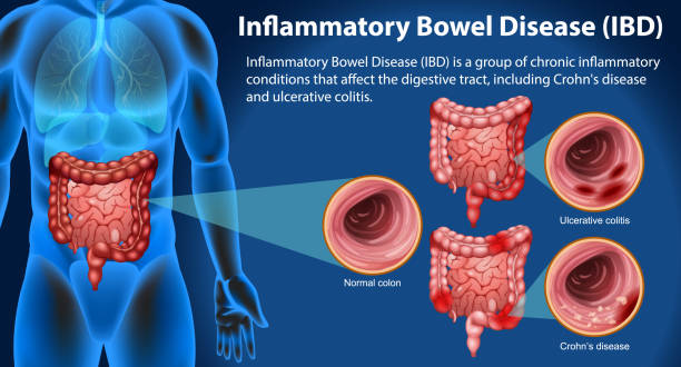 干細胞終結炎癥性腸??？8大問(wèn)題解答揭秘細胞療法如何改寫(xiě)治療規則