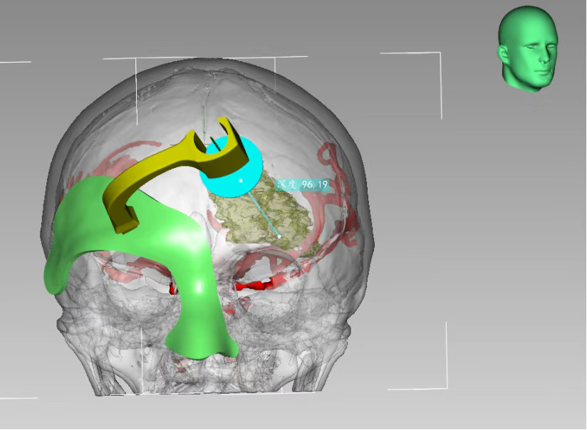 3D打印技術(shù)定位下腦內血腫穿刺術(shù)