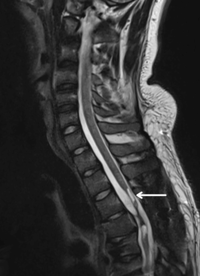 圖2：X射線(xiàn)圖像顯示慢性期脊髓損傷，通常以囊腫形成為特征，如白色箭頭所示