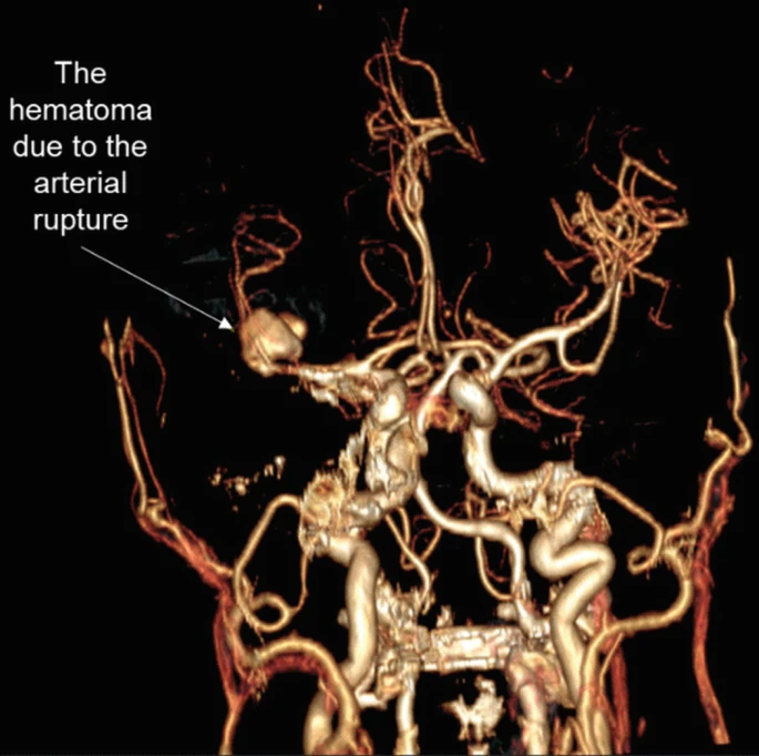 圖2:出血導致中風(fēng) 圖2:出血導致中風(fēng)