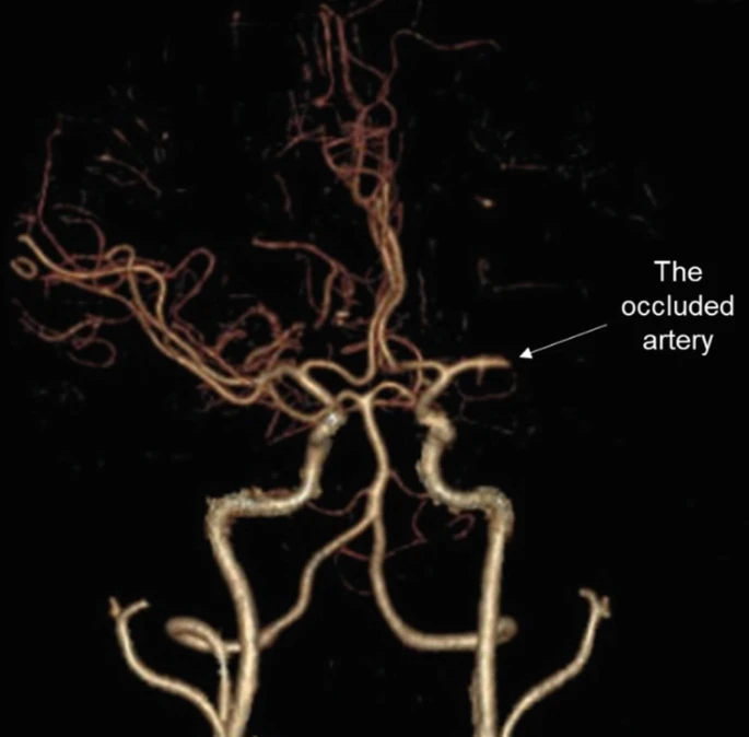 圖1:動(dòng)脈閉塞導致的缺血性中風(fēng) 圖1:動(dòng)脈閉塞導致的缺血性中風(fēng)