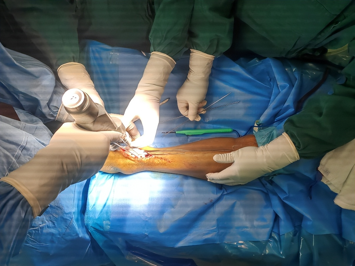 術(shù)中截骨導板輔助下精準截骨并安放假體