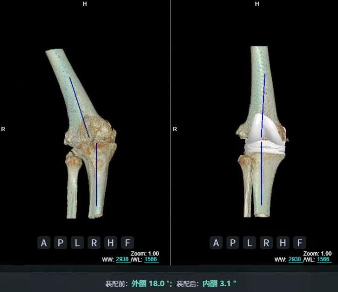 AI精準關(guān)節置換