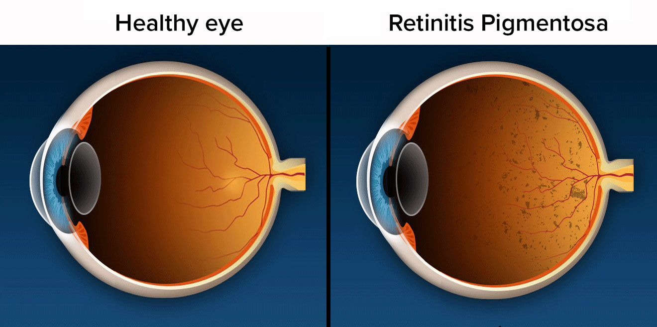 視網(wǎng)膜色素變性