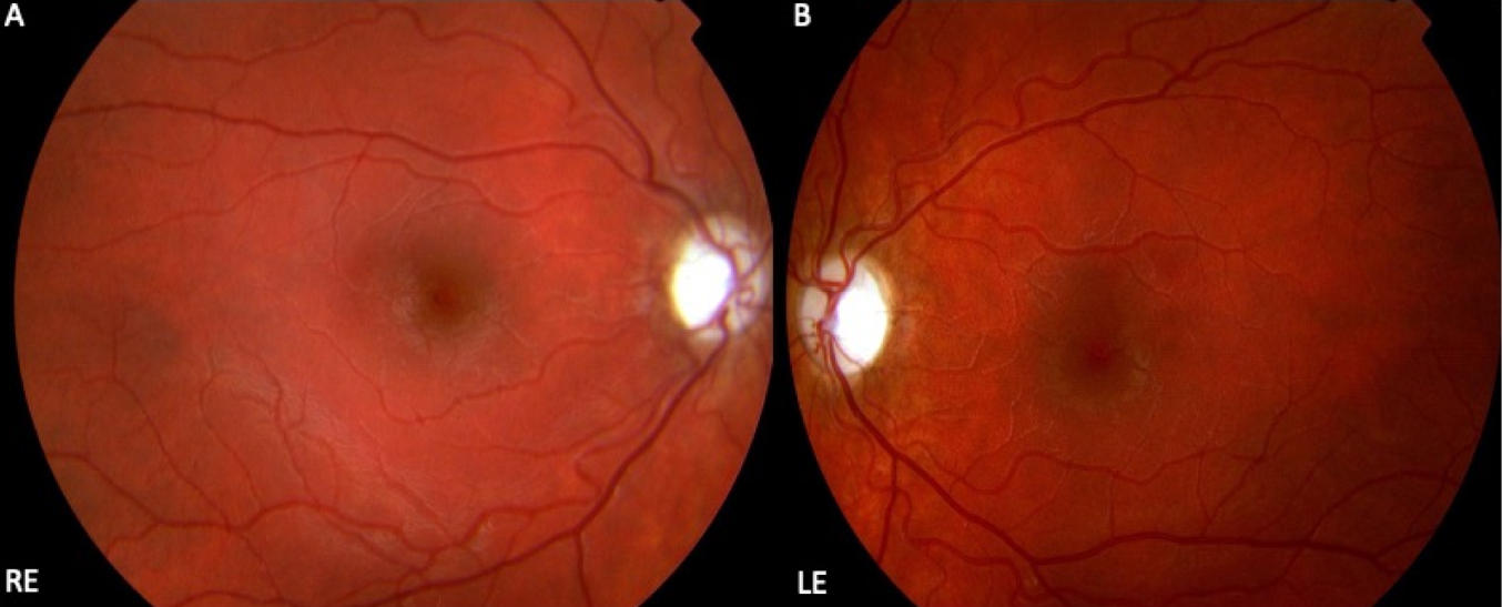 遺傳性視神經(jīng)病變