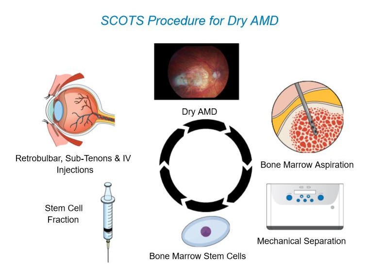 干細胞治療年齡相關(guān)黃斑變性