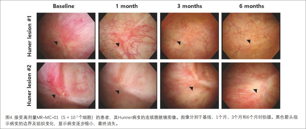 間質(zhì)性膀胱炎臨床試驗